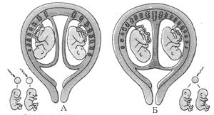 Развитие неидентичных и идентичных близнецов (А и Б )