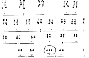 47 хромосом у человека с болезью Дауна