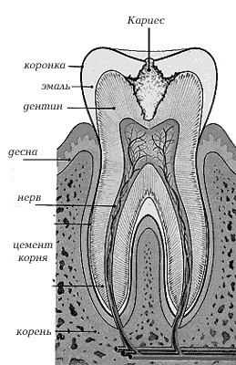 Схема развития кариеса