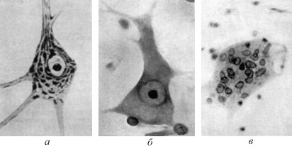 Рис. 2.  Схема разрушения нейрона: а – нормальный нейрон, б – начальная стадия повреждения под действием наркотика, в – погибший нейрон