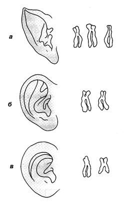Разная форма ушной раковины: при генетических нарушениях – а, б; норма – в