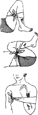 Приемы остановки кровотечений
